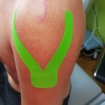 Kinesiotaping, plastrowanie dynamiczne